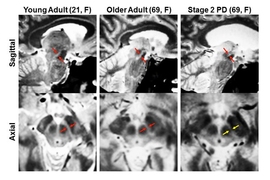 MIT neuroscientists imaged the substantia nigra in a young adult, left, an older adult, center, and a Parkinson’s patient, right. They found that the substantia nigra deteriorates in Parkinson’s patients.