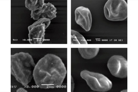 In the red blood cells on the right, MIT engineers used CRISPR to knock out the gene for a malarial protein called kahrp. This protein is present in the cells on the left, giving them a distinctive knobby appearance.