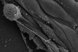 A rounded cancer cell (top left) sends out nanotubes connecting with endothelial cells. Genetic material can be injected via these nanotubes, transforming the endothelial cells and making them more hospitable to additional cancer cells.