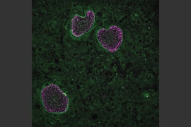 In this image, four Plasmodium vivax parasites have invaded human hepatocytes. Three of the parasites are developing while one parasite, on the lower right, is a dormant hypnozoite, which remains small until its reactivation.
