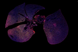 A strong immune response can be seen in this immunofluorescence image of lung tissue infected with pneumonia where immune cells are stained green and red.