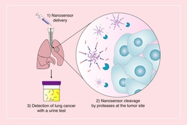 MIT engineers have developed nanoparticles that can be delivered to the lungs, where tumor-associated proteases cut peptides on the surface of the particles, releasing reporter molecules. Those reporters can be detected by a urine test.