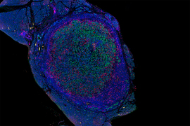 pancreatic tumor