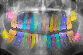 dental X ray with colored overlays for each tooth