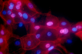 Human breast cancer cells